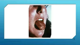 Strep Throat