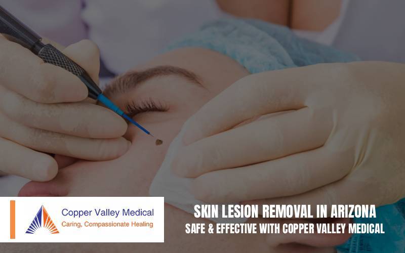 Skin Lesion Removal in Arizona – Safe and Effective with Copper Valley Medical