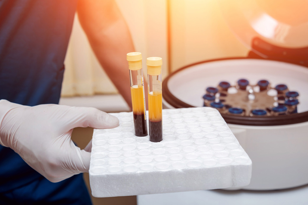 Platelet Rich Plasma
